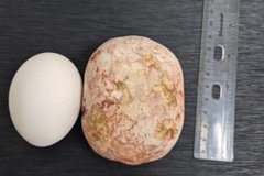 Гигантский камень извлекли медики из россиянина